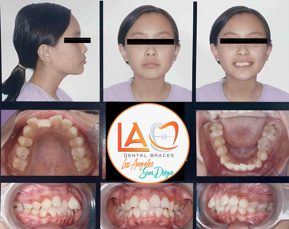 Before and After Photos LA Dental Braces